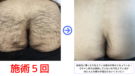 横浜のメンズ脱毛/完全都度払いで安い男性専用脱毛サロン
